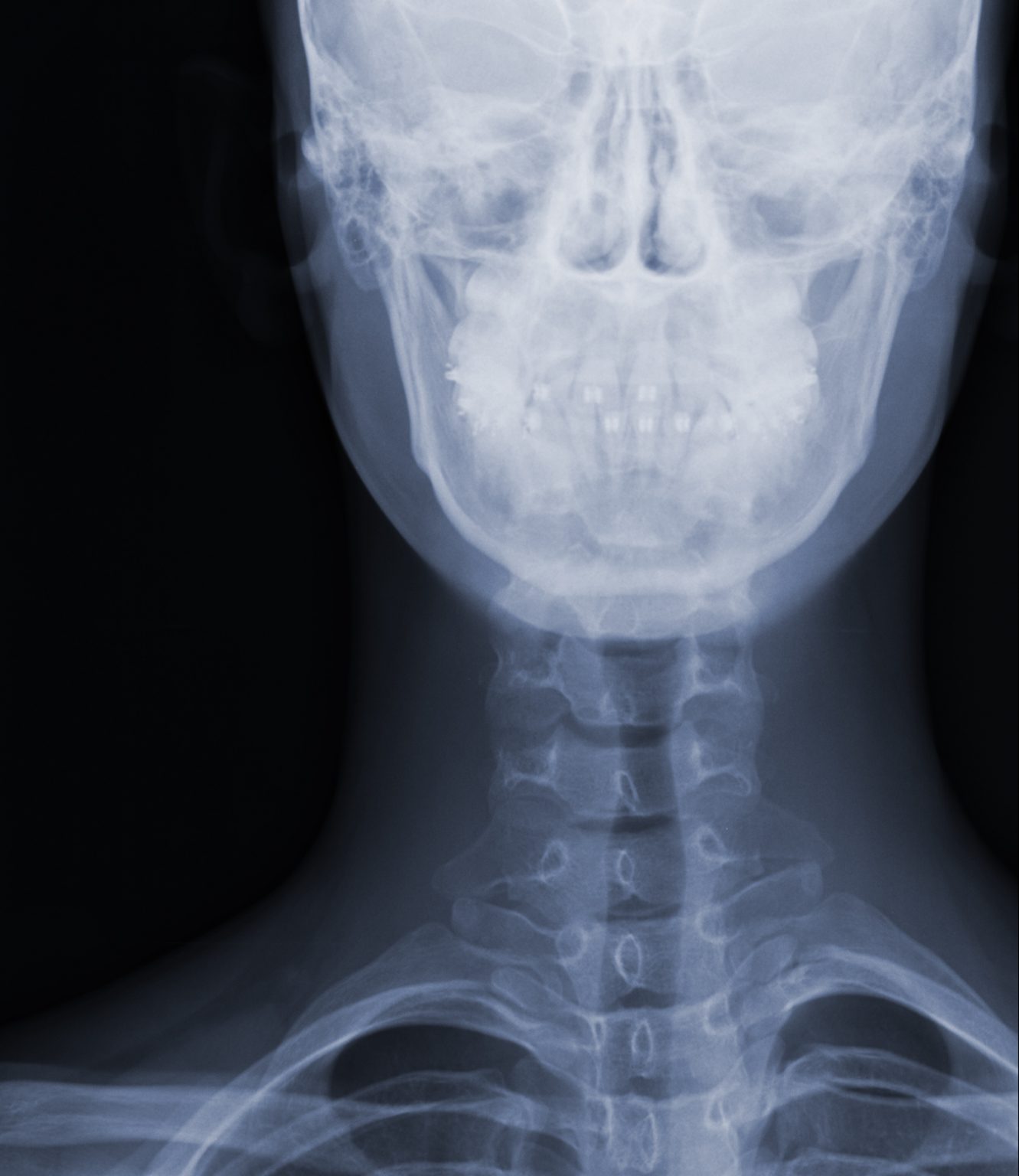 CRANEO LATERAL