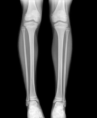 FEMUR DERECHO LATERAL