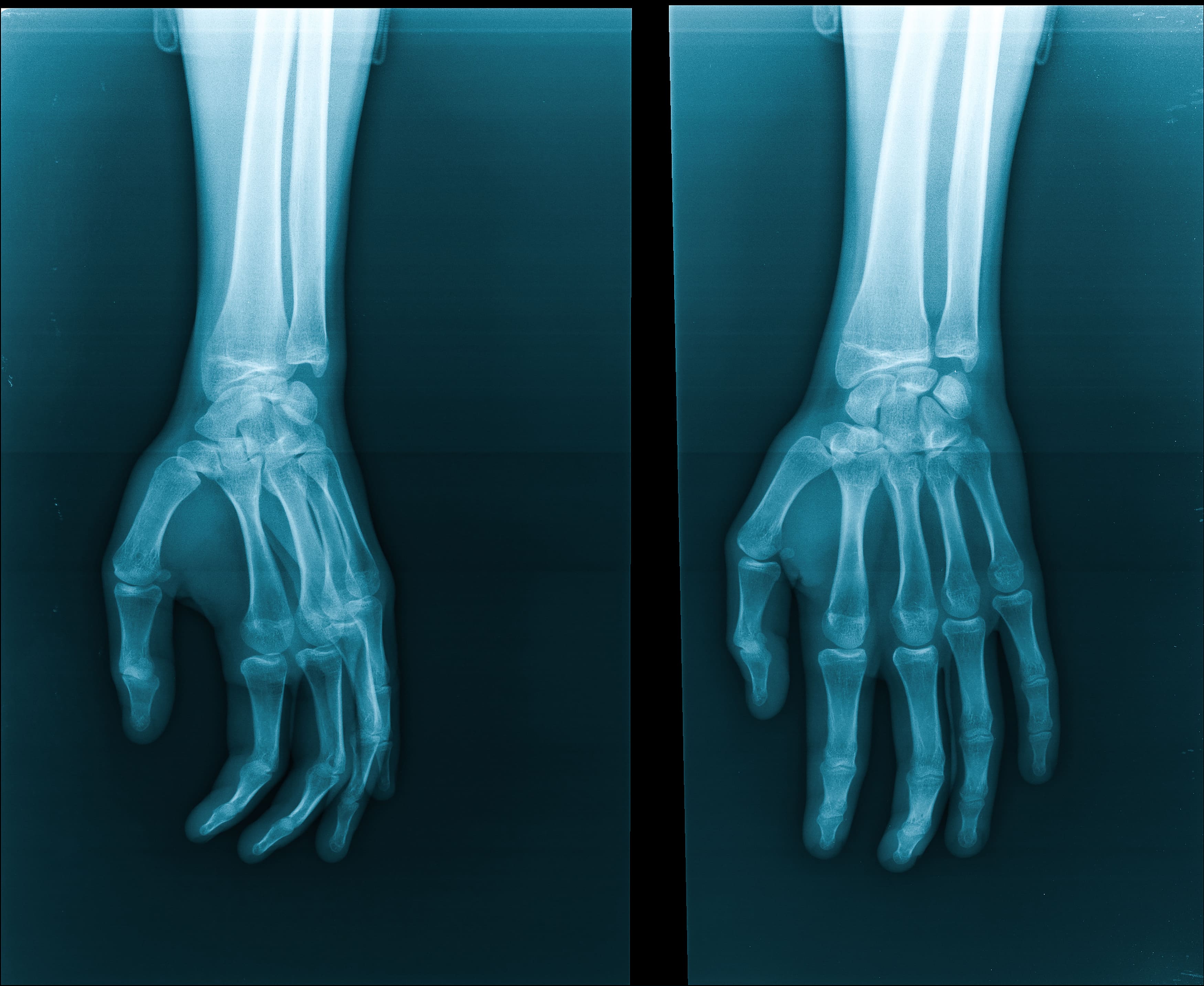 MANO LATERAL DERECHO