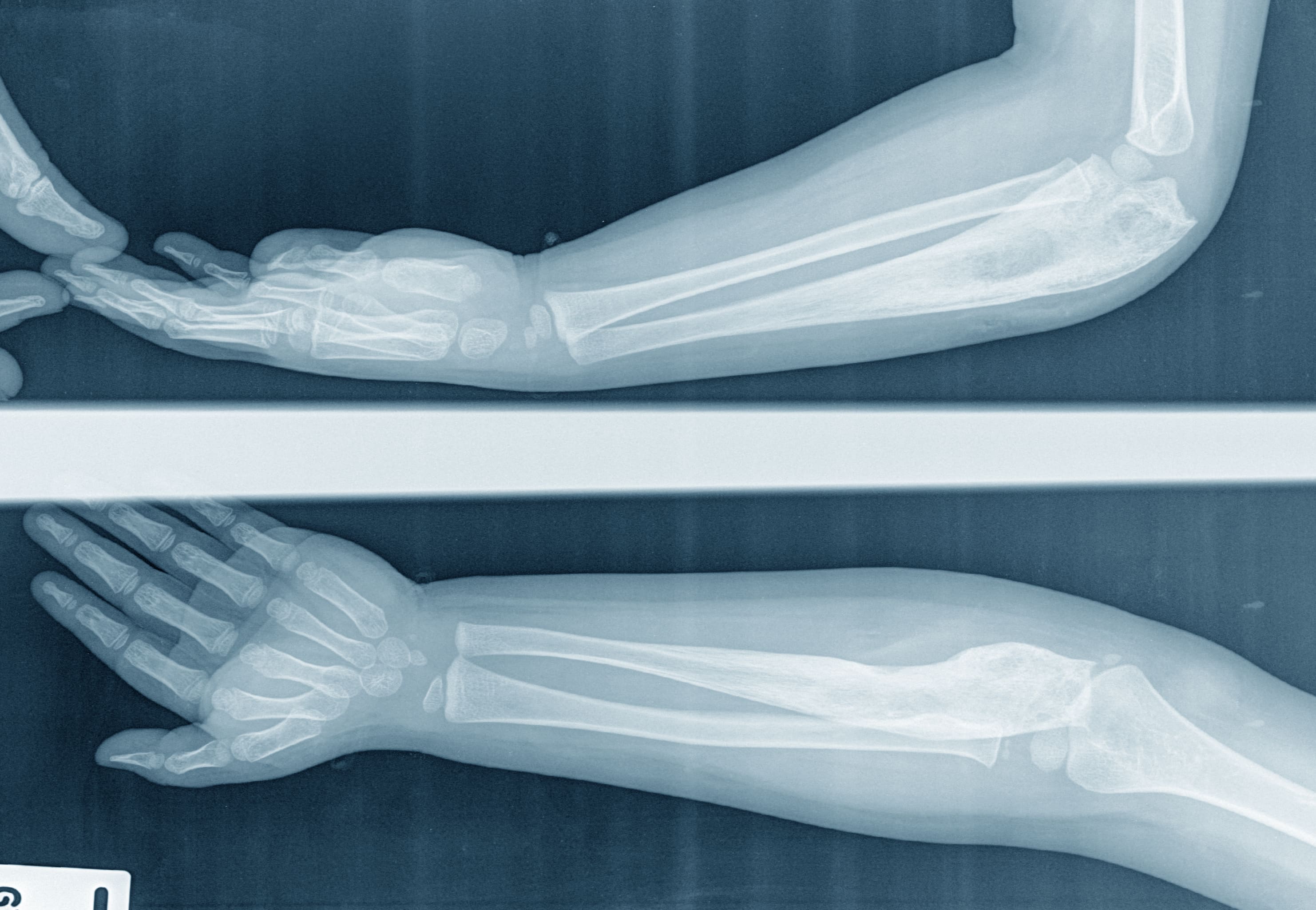 BRAZO ANTERO POSTERIOR DERECHO