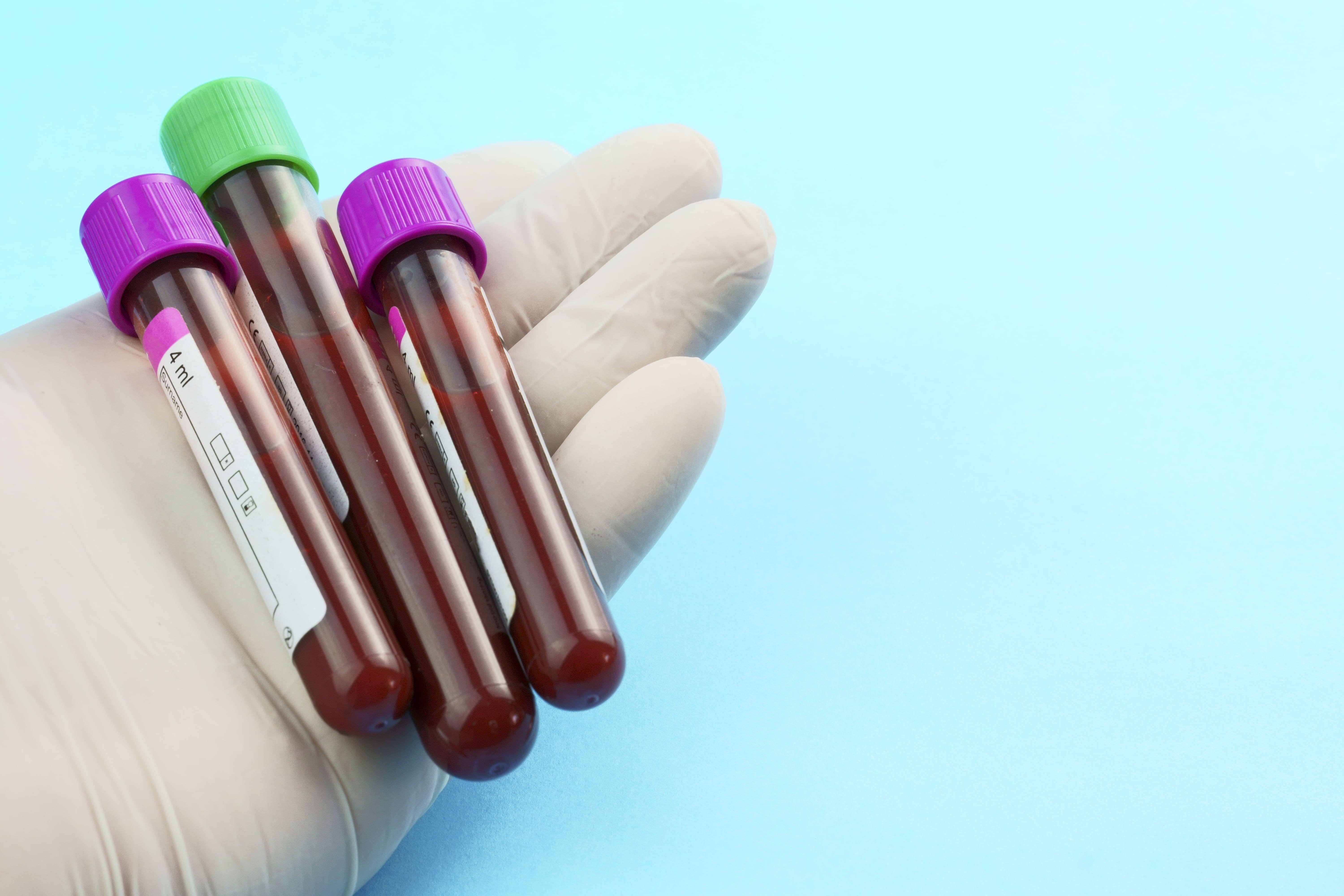 ACS. ANTI HELICOBACTER PILORY IgG