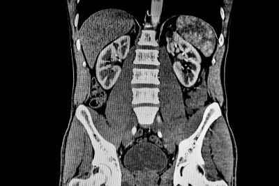 TOMOGRAFIA DE ABDOMEN SIMPLE (SUBROGADO)
