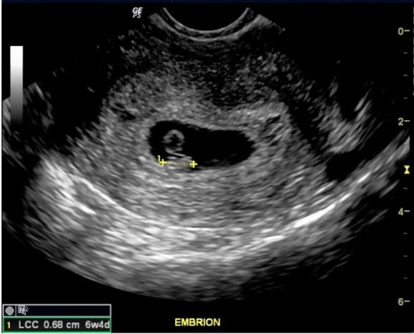 US DOPPLER 1 EXTREMIDAD ARTERIAL Y VENOSA